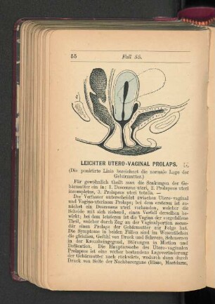 Leichter Utero-Vaginal Prolaps.