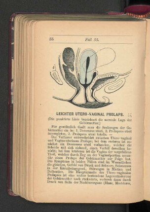 Leichter Utero-Vaginal Prolaps.