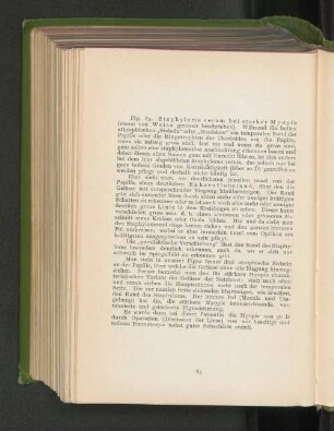 Fig. 85. Staphyloma verum bei starker Myopie.