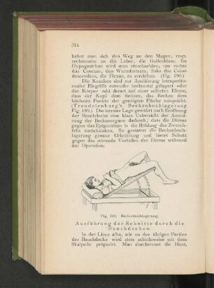 Fig. 189. Beckenhochlagerung.