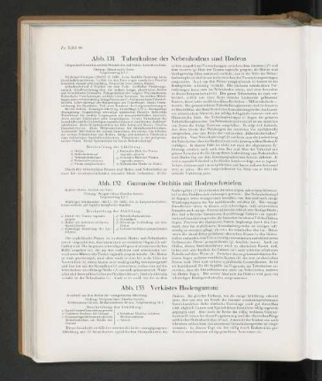 Abb. 131 Tuberkulose des Nebenhodens und Hodens