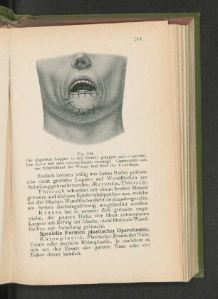 Fig. 155. Der abgelöste Lappen in den Defekt gelagert und eingenäht.