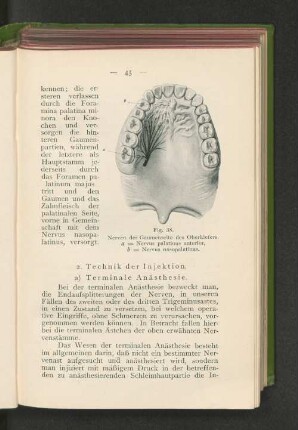 2. Technik der Injektion.