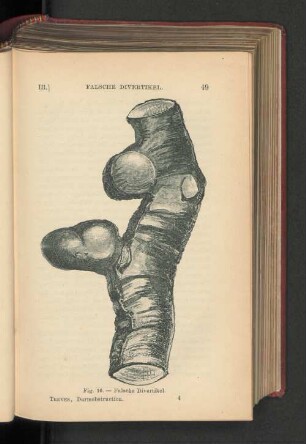 Fig. 16. - Falsche Divertikel.