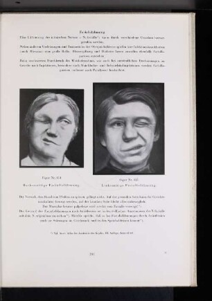 Figur Nr. 415 Linksseitige Facialislähmung.