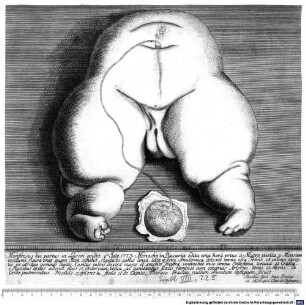 Monstrosus hic partus in Lucem prodiit .4.ta Julij 1773 Monachij in Bavaria edita una hora prius a Matre puella 9 Mensium incolumi: figura erat, quam Icon exhibet 10. polices gallos longa, lata 8: sectio Anatomica detexit omnia ossa Pelvis, et pedum exceptis in utroque geminis digitis, Cavitas pelvis dextra major, et amplior sinistra, continebat in se omnia ...
