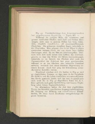 Fig. 42. Veränderung des Augengrundes bei angeborener Syphilis - Typus III.