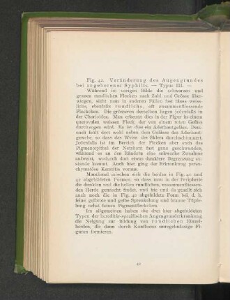 Fig. 42. Veränderung des Augengrundes bei angeborener Syphilis - Typus III.