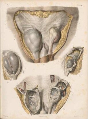 Hernien in der Leistengegend