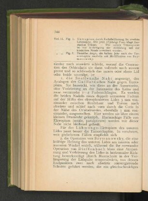 1. Die Snellensche Naht.