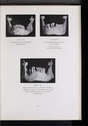 Figur Nr, 428 Paradentalschwund am Unterkiefer eines Australier. (Aus der Sammlung von Herrn Prof. Klaatsch, Breslau.)