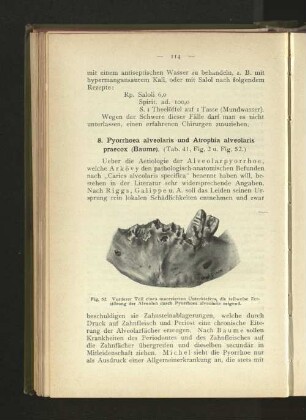 8. Pyorrhoea alveolaris und Atrophia alveolaris praecox (Baume).