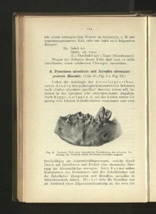 8. Pyorrhoea alveolaris und Atrophia alveolaris praecox (Baume).