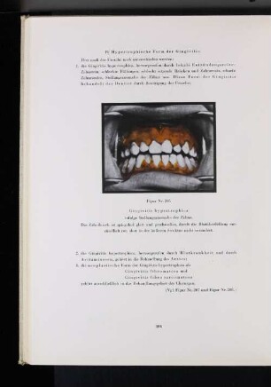 Figur Nr. 205 Gingivitis hypertrophica