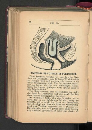 Inversion des Uterus im Puerperium.