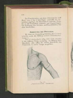 Amputation des Oberarmes.