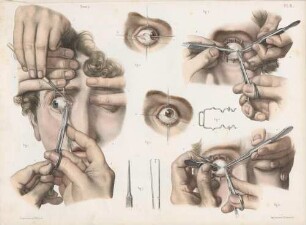 Operation schielender Augen