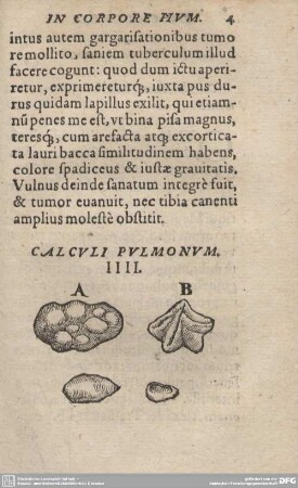 CALCULI PULMONUM. IIII.