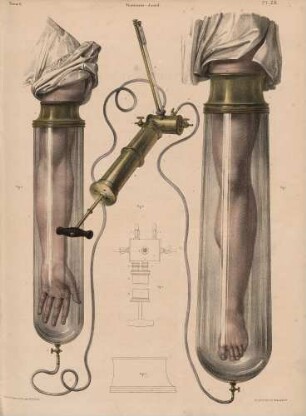 Unterdruckglocke für Arm und Bein