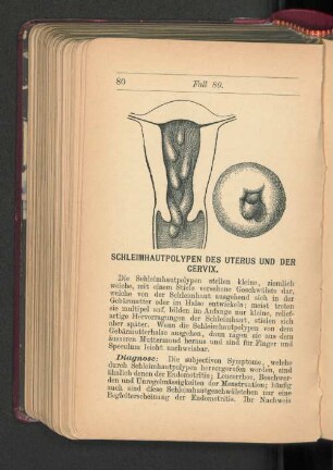 Schleimhautpolypen des Uterus und der Cervix.