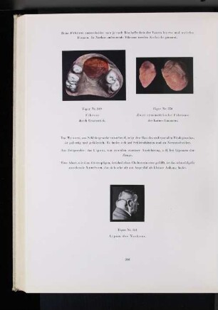 Figur Nr. 350 Zwei symmetrische Fibrome des harten Gaumens.