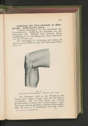 Fg. 93. Enucleation im Kniegelenke. Konturen der Lappen.