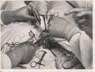 Hamburg-Hohenfelde. Katholisches Marienkrankenhaus. Eine Operation. Das kranke Organ ist von den Chirurgen freigelegt. Der Krankheitsherd ist sichtbar