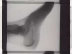 Röntgenkinematographische Studien über die Bewegungen des Kniegelenks und der Gelenke des Fußes