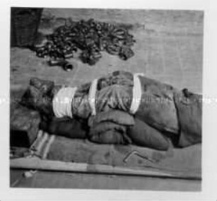 Unterschenkelbruch und Verrenkung des Kniegelenkes