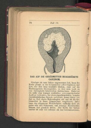 Das auf die Gebärmutter beschränkte Carcinom.