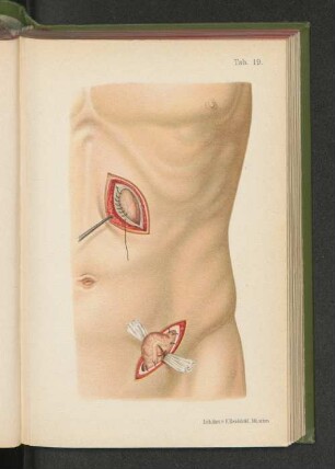 Tab. 19. Gastrostomie.