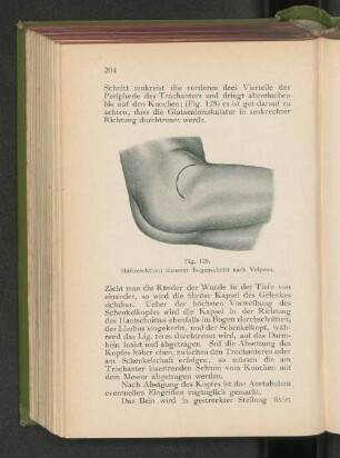 Fig. 128. Hüftresektion; äusserer Bogenschnitt nach Velpeau.