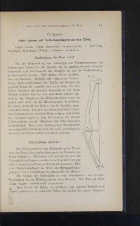 VI. Kapitel. Genu varum und Verkrümmungen an der Tibia.