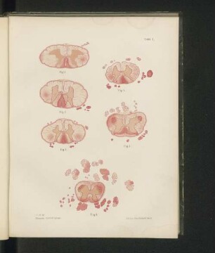 Zur pathologischen Anatomie der chronischen progressiven Ophthalmoplegie (Ophthalmoplegia nuclearis)