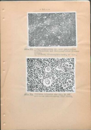 Abb. 15: Paragranulomatose mit sehr reichlichen Hodgkinzellen und Sternberg'schen Riesenzellen. Abb. 16: Gleiches Präparat wie Abb. 15 bei stärkerer Vergrösserung (432 fach).