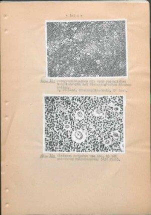 Abb. 15: Paragranulomatose mit sehr reichlichen Hodgkinzellen und Sternberg'schen Riesenzellen. Abb. 16: Gleiches Präparat wie Abb. 15 bei stärkerer Vergrösserung (432 fach).