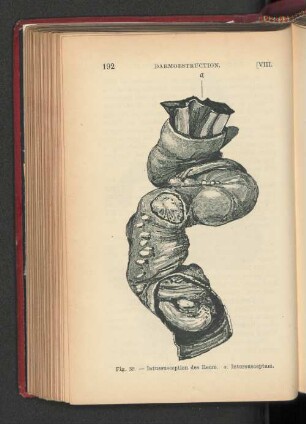 Fig. 39. - Intussusception des Ileum.