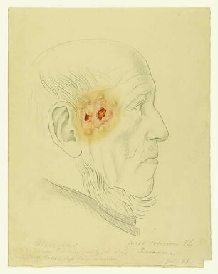 Ulcus rodens? Krankenbildnis Jacob Petersen