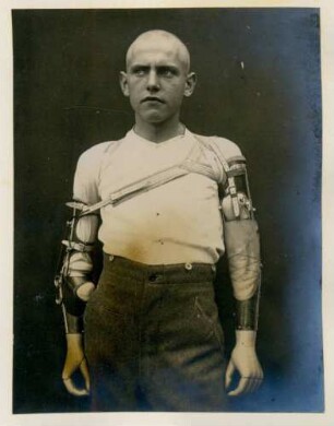 Foto eines an beiden Armen amputierten Mannes mit doppelter, gestreckter Armprothese im Kngl. Reservelazarett in Singen