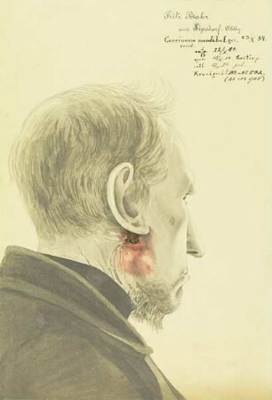 Carcinoma mandibul. recid. Krankenbildnis Fritz Bahr