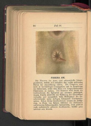 Fissura Ani.