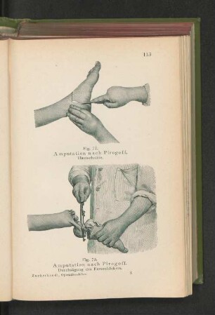 Fig. 72. Amputation nach Pirogoff. Hautschnitte.