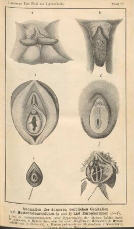 Tafel I. - Anomalien der äusseren weiblichen Genitalien bei Hottentottenweibern (a und b) und Europäerinnen (c-f)