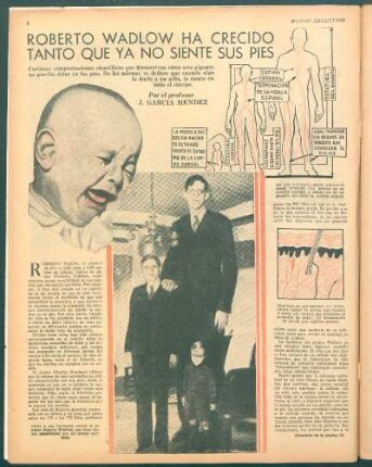 Roberto Wadlow ha crecido tanto que ya no siente sus pies : Curiosas comprobaciones científicas que demuestran cómo este gigante no percibe dolor en los pies. De las mismas se deduce que cuando algo le duele a un niño, lo siente en todo el cuerpo
