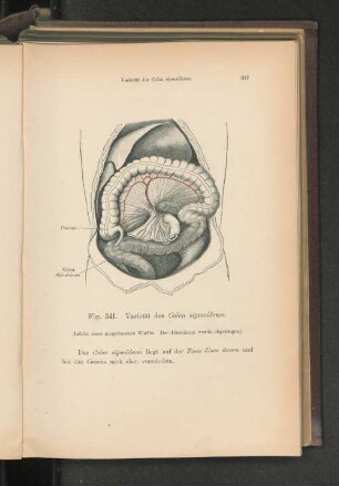 Fig. 341. Varietät des Colon sigmoideum.