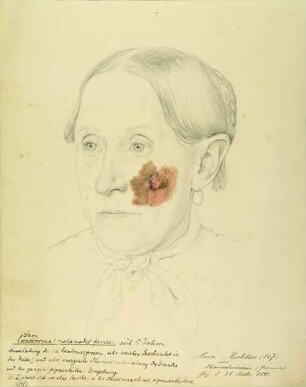 Sacroma melanodes faciei. Krankenbildnis Anna Richters