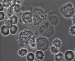 Leukozyten (Homo sapiens) - Morphologische Veränderungen unter Einwirkung von Leukozidin aus Pseudomonas aeruginosa in vitro