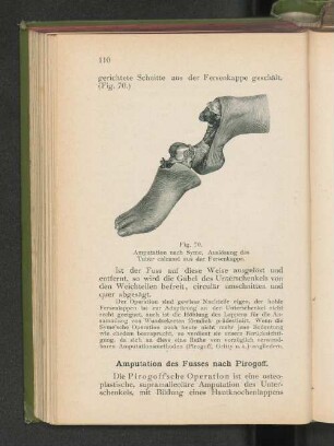 Fig. 70. Amputation nach Syme. Auslösung des Tuber calcanei aus der Fersenkappe.