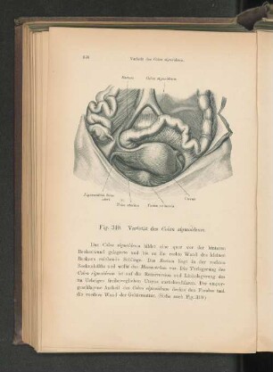 Fig. 340. Varietät des Colon sigmoideum.