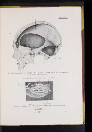 237 Unterhorn des Seitenventrikels. Frontalschnitt. Hippocampus. Plexus chorioideus.